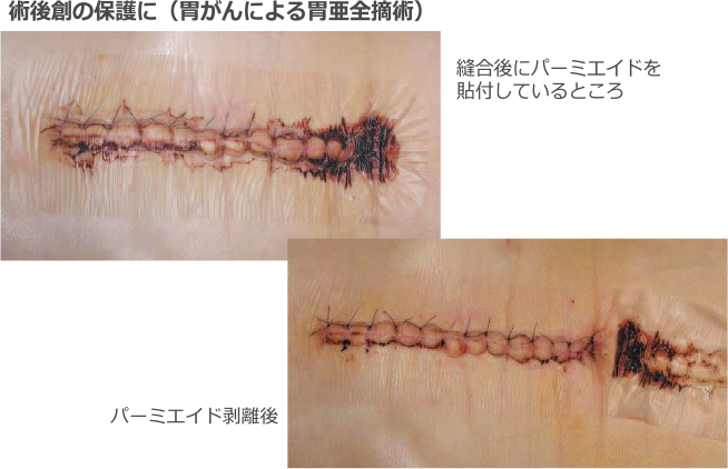 術後創の保護に(胃がんによる胃亜全摘出)