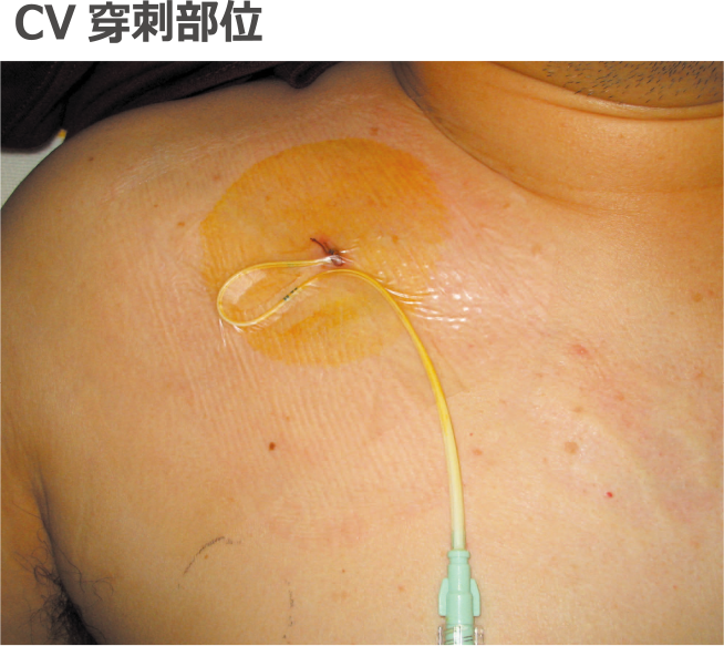 CV穿刺部位